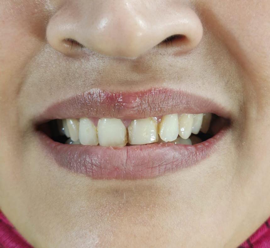 Before treatment